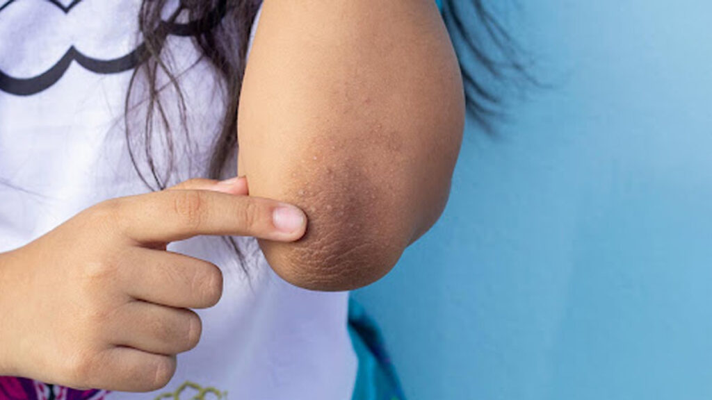 నల్లటి మోచేతులను ప్రకాశవంతంగా మరియు మృదువుగా చేసేందుకు సహజ చిట్కాలు