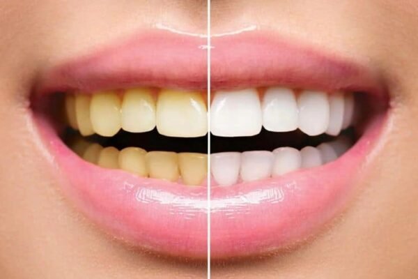 Tips-for-Preventing-Yellow-Teeth