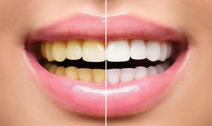 Tips-for-Preventing-Yellow-Teeth