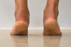 పాదాల పగుళ్లను తగ్గించడానికి ఈ చిట్కాలు తెలుసుకోండి!