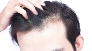 మగవాళ్లు జుట్టు రాలకుండా ఉండాలంటే ఇలా చెయ్యండి..