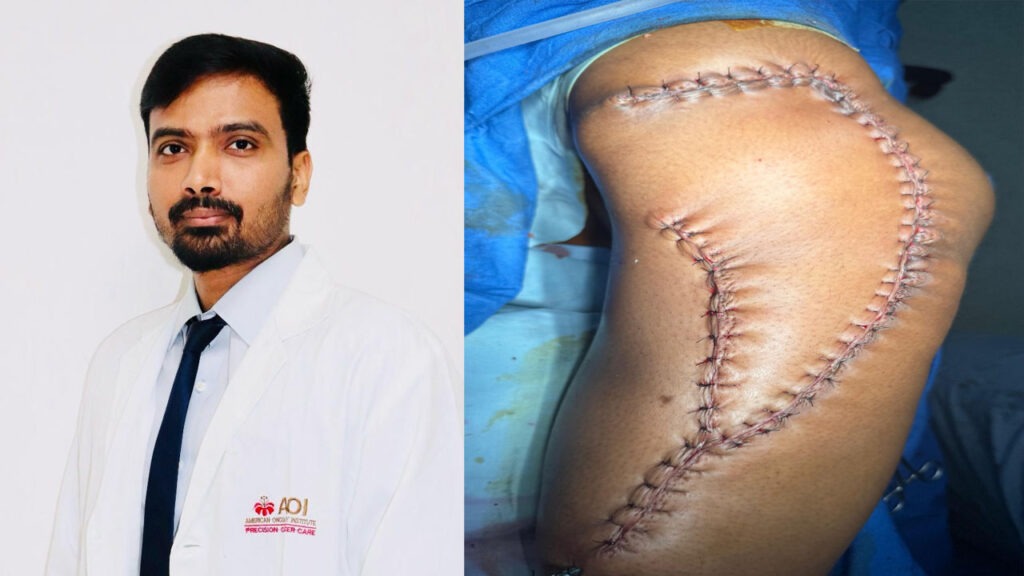 18 ఏళ్ల బాలికకు ఎక్స్‌ట్రాసోసియస్ ఆస్టియోసార్కోమా చికిత్స