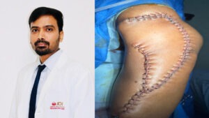 18 ఏళ్ల బాలికకు ఎక్స్‌ట్రాసోసియస్ ఆస్టియోసార్కోమా చికిత్స