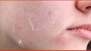 డ్రై స్కిన్ మిమ్మల్ని నిద్ర పట్టకుండా చేస్తుందా..? అయితే మీరు ఇవి తినాల్సిందే..!!