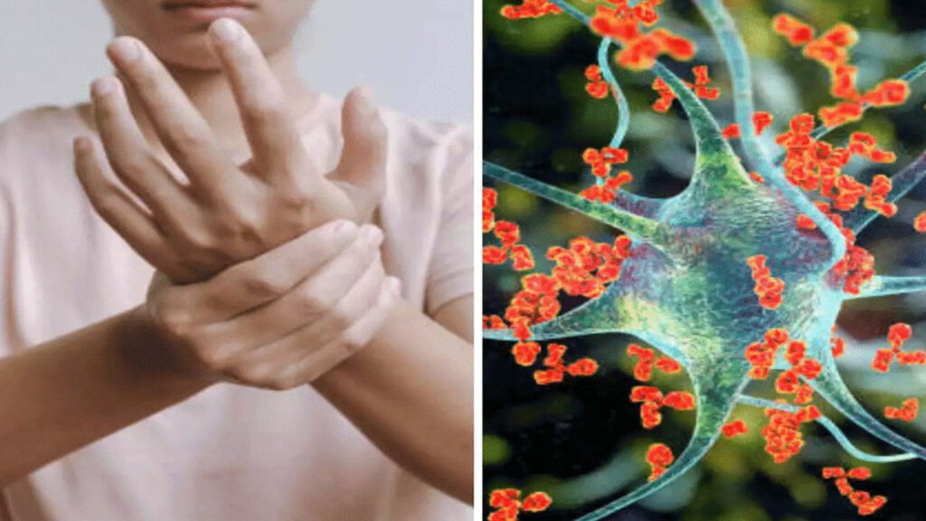 తూర్పు గోదావరి జిల్లాలో జీబీఎస్ కేసుల కలకలం