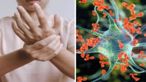 తూర్పు గోదావరి జిల్లాలో జీబీఎస్ కేసుల కలకలం