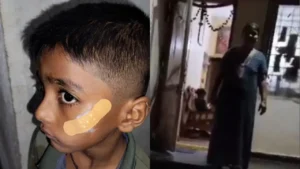 కుట్లు వేయడానికి బదులుగా ఫెవిక్విక్‌ని ఉపయోగించిన నర్సు