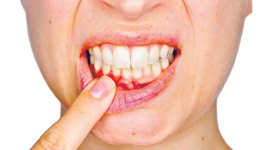 Periodontal Problems : చిగుళ్ల నుంచి రక్తం-గుండె ముప్పుకు సంకేతం
