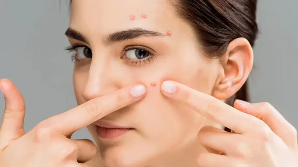 Pimples: మొటిమలకు కారణాలు..నివారణలు