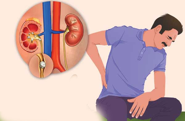 Kidney stones: కిడ్నీలలో రాళ్లకు కనిపించే లక్షణాలు..నివారణలు