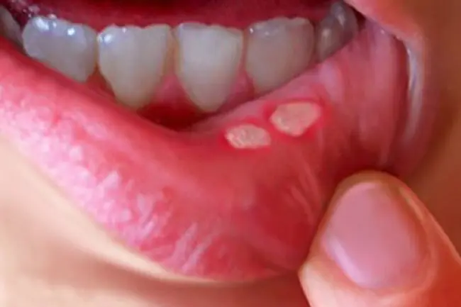 Mouth ulcers  :నోటి పూతలు ఎందుకు వస్తాయో తెలుసా..? 