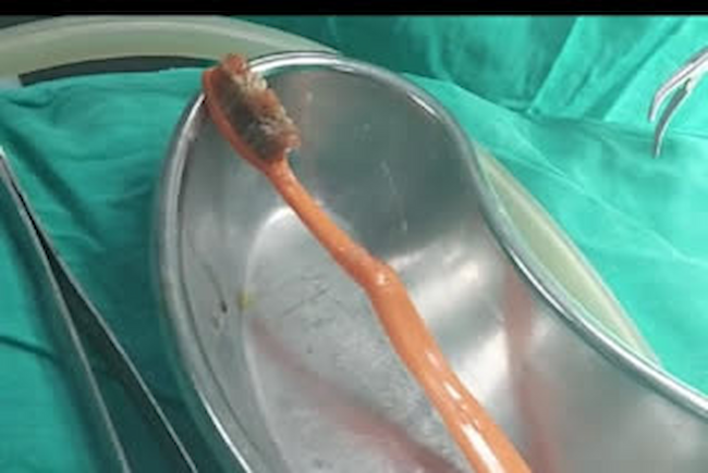 Yang: 12 ఏళ్ల వయసులో మింగిన బ్రష్..52 ఏళ్ల తర్వాత బయటకు..