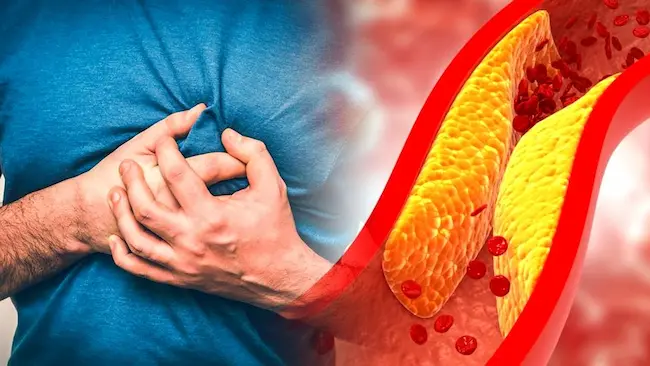 High cholesterol: అధిక కొలెస్ట్రాల్ ఇచ్చే ముప్పులు