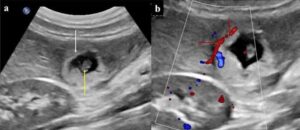 మహిళ లివర్లో 12 వారాల పిండం