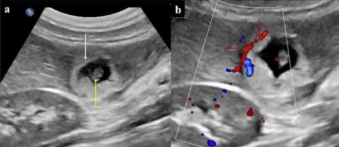 OMG : మహిళ లివర్లో 12 వారాల పిండం