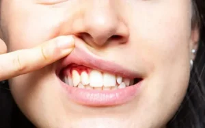 చిగుళ్ల నుంచి రక్తం రావడాన్ని నిర్లక్ష్యం చేయొద్దు..