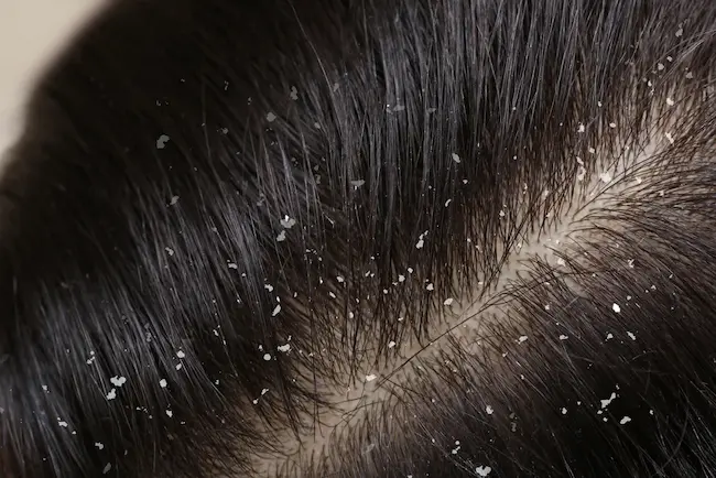  Dandruff : చుండ్రుతో ఇబ్బందులు పడుతున్నారా ..అయితే  టిప్స్‌ను పాటించండి!