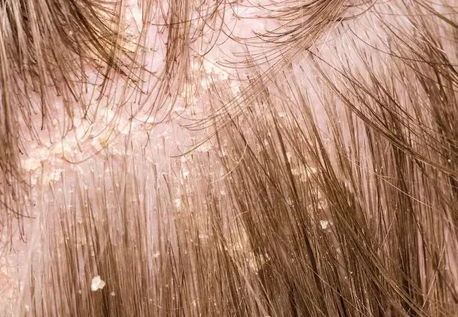  Dandruff : చుండ్రుతో ఇబ్బందులు పడుతున్నారా ..అయితే  టిప్స్‌ను పాటించండి!