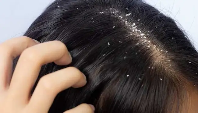 Dandruff : చుండ్రుతో ఇబ్బందులు పడుతున్నారా ..అయితే టిప్స్‌ను పాటించండి!