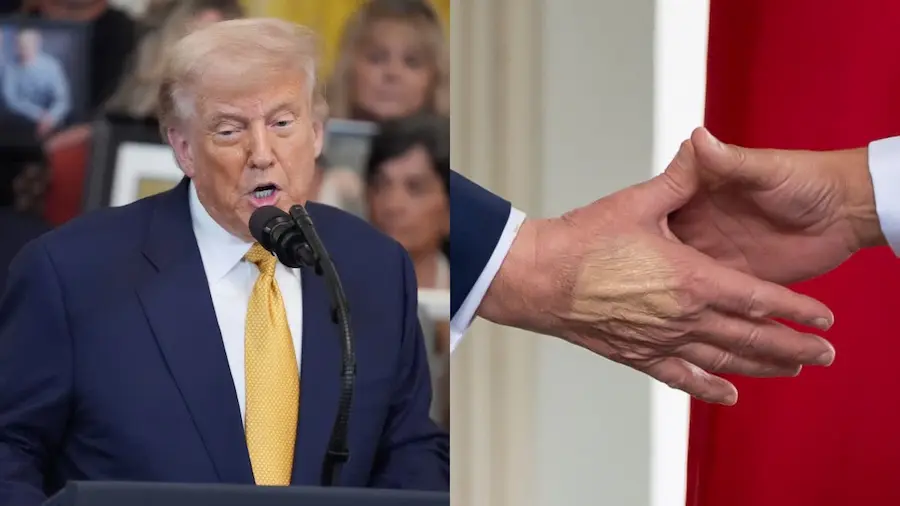 Trump: ట్రంప్‌కు “వీనస్ ఇన్సఫిషియెన్సీ” – భయపడాల్సిన అవసరం లేదు: వైట్‌హౌస్