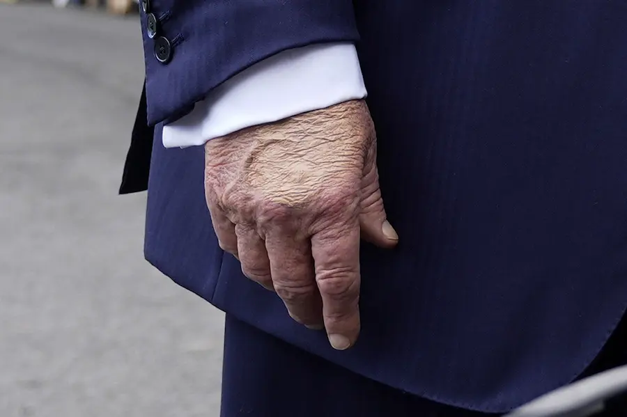 Trump: ట్రంప్‌కు "వీనస్ ఇన్సఫిషియెన్సీ" – భయపడాల్సిన అవసరం లేదు: వైట్‌హౌస్ 