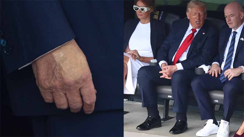 Donald Trump : కాళ్ల సిరల వ్యాధితో బాధపడుతున్న డొనాల్డ్ ట్రంప్