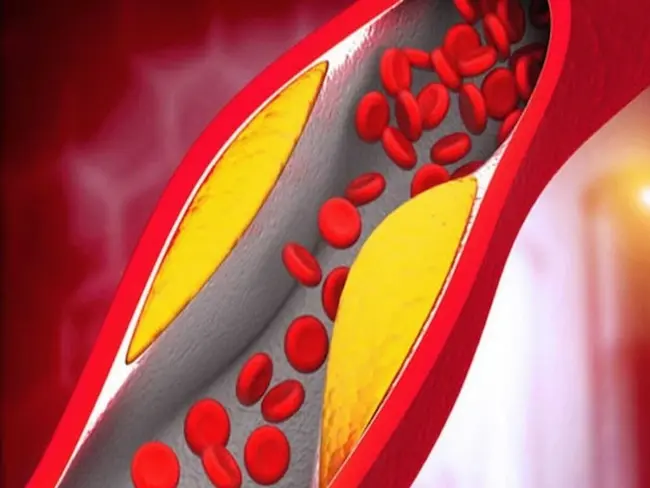 Cholesterol: శరీరంలో కొలెస్ట్రాల్ ఎక్కువైతే కనిపించే లక్షణాలు