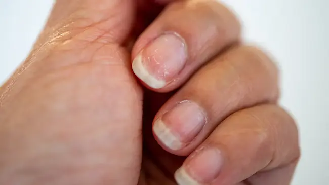 Nails : గోర్లు చెబుతున్న ఆరోగ్య రహస్యాలు ..చిన్న మార్పులతో పెద్ద సంకేతాలు!