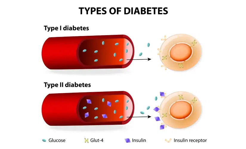 Diabetes - ఆడవారిలో టైప్ 1, మగవారిలో టైప్ 2 ప్రమాదం - తాజా అధ్యయనం