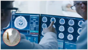 ఆమెకు తరచూ తలనొప్పి..మెదడులో దాన్ని చూసి డాక్టర్లు షాక్