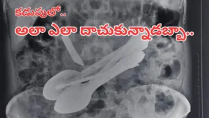 వ్యక్తి కడుపులో నుంచి బయటపడ్డ 29 స్పూన్లు, 19 టూత్‌బ్రష్‌లు