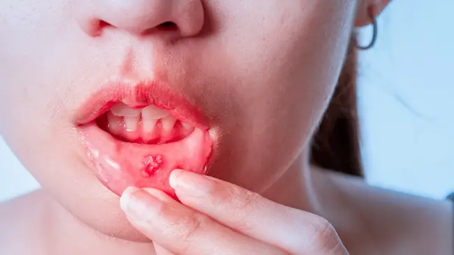 Mouth Ulcers - నోట్లో పుండ్లు ఏర్ప‌డకుండా ఈ చిట్కాల‌ను పాటించండి..!