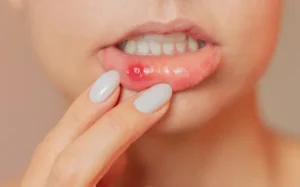 Mouth Ulcers – నోట్లో పుండ్లు ఏర్ప‌డకుండా ఈ చిట్కాల‌ను పాటించండి..!