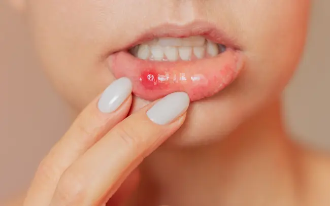 Latest Telugu News : Mouth Ulcers – నోట్లో పుండ్లు ఏర్ప‌డకుండా ఈ చిట్కాల‌ను పాటించండి..!