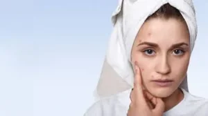 ఈ చిట్కాలు పాటిస్తే పింపుల్స్ మాయం