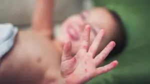 మధ్యప్రదేశ్‌లో టమాటా వైరస్ విజృంభణ