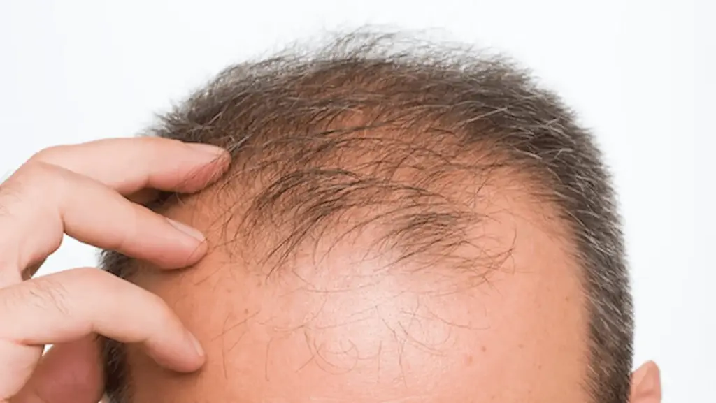 News Telugu: Hair Growth: బట్టతల వారికి శుభవార్త! కేవలం 20 రోజుల్లోనే జుట్టు పెంచే సీరం