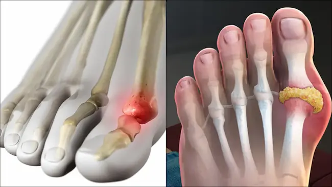 Latest Telugu News : Gout : గౌట్ ఉన్న‌వారు పాటించాల్సిన చిట్కాలు..