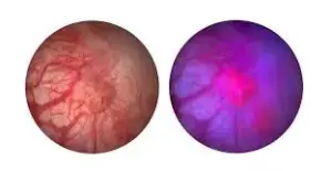 మూత్రాశయ క్యాన్సర్‌కు విప్లవాత్మక పరిష్కారం