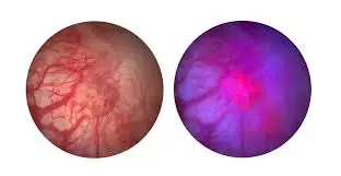 Latest News: TAR-200: మూత్రాశయ క్యాన్సర్‌కు విప్లవాత్మక పరిష్కారం