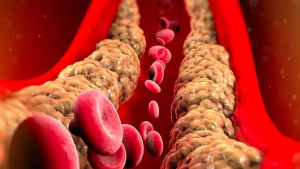 These are the symptoms of high cholesterol