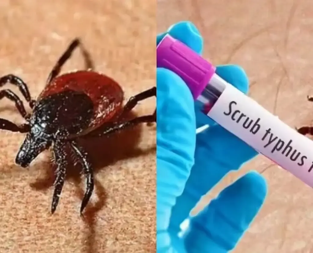 AP: 20 కి చేరిన స్క్రబ్ టైఫస్ మృతుల సంఖ్య