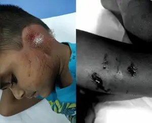 ఘోరం.. బాలుడి చెవి కొరికేసిన కుక్క