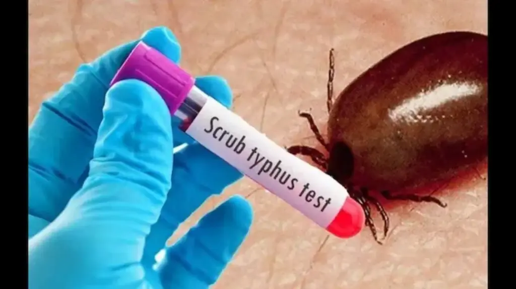 News Telugu: Scrub Typhus: స్క్రబ్ టైఫస్‌తో మూడుకు చేరిన మొత్తం మరణాల సంఖ్య