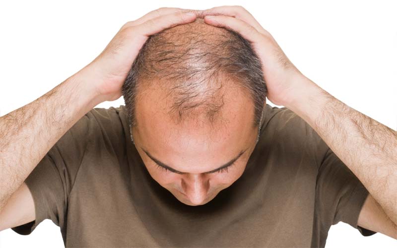 Baldness Problem : సౌత్ కొరియాను వేధిస్తున్న బట్టతల సమస్య