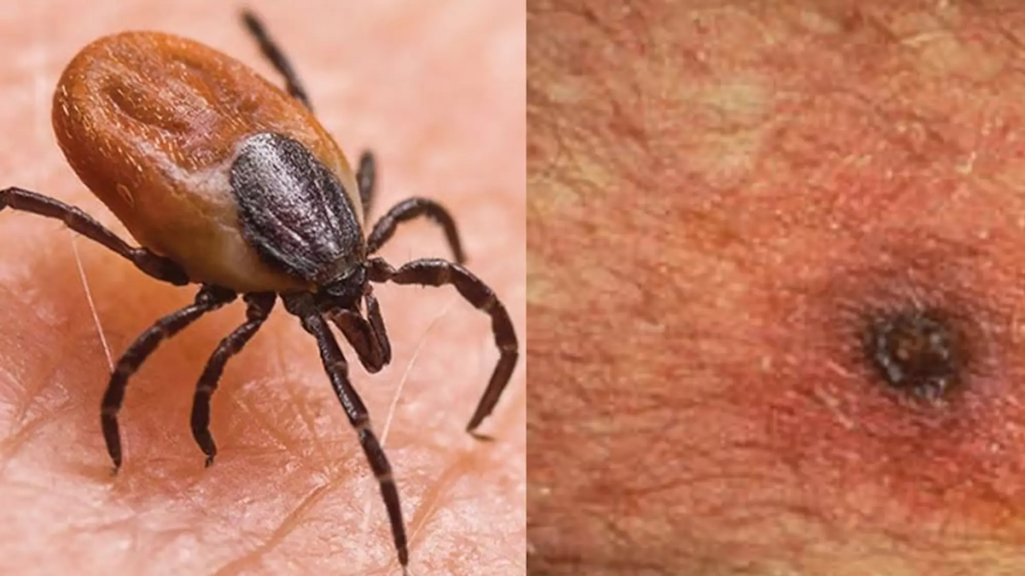 AP Scrub Typhus: కలవర పెడుతున్న కొత్త జ్వరాలు!