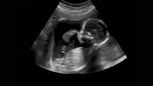 ప్రభుత్వ ఆస్పత్రుల్లో ఫ్రీగా TIFFA సేవలు – మంత్రి సత్యకుమార్