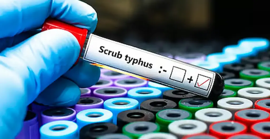 Scrub typhus disease is spreading in AP