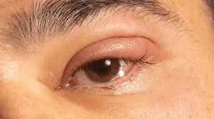 కిడ్నీ సమస్యలను గుర్తించే కంటి సంకేతాలు