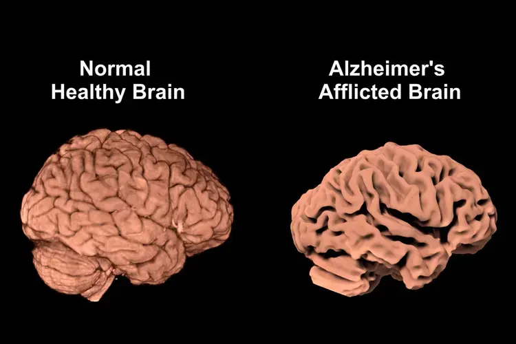 Alzheimer’s Disease